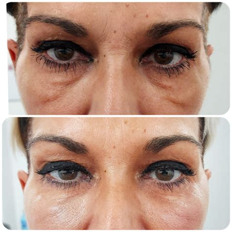 casos reales ojeras dra raquel saez vigo