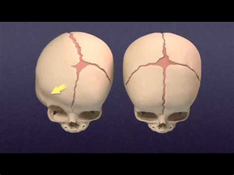 Craniosynostosis - Mayo Clinic - YouTube