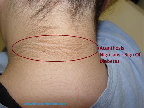 darkening  neck sign  diabetes dr nikhil prabhus blog
