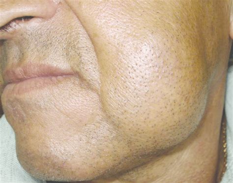 Patient with a growing mass involving the left cheek. | Download ...