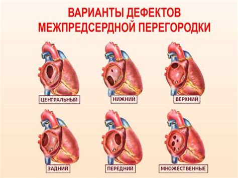 Врожденные пороки сердца у детей - презентация онлайн