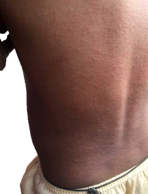 Infant Toddler And Children Rashes Rashes In Children