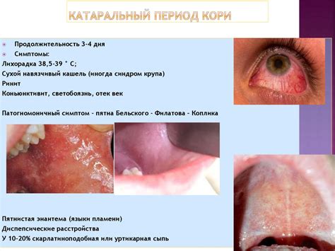 Корь у детей - презентация онлайн