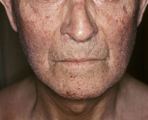 Systemic Sclerosis Prognosis - Rare Disease Advisor