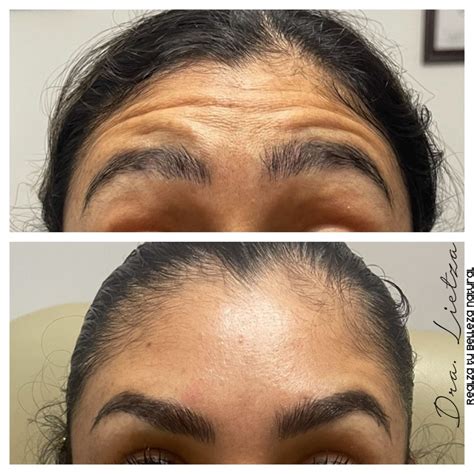 Resultados de Botox - Fotos Antes y Después - Dra Lietza - Salud y Belleza