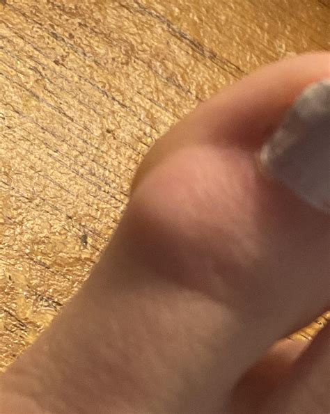 Painful bump on big toe. Does anybody know what this could be? : r ...