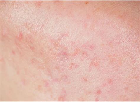 red spots  skin pictures photo gallery  skin pictures  pink