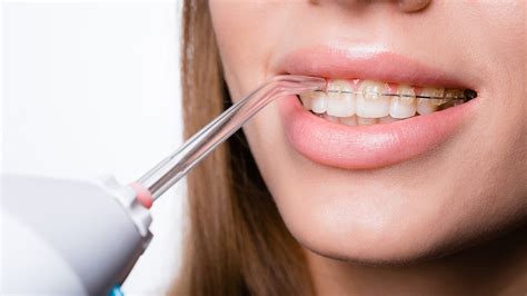 Best Water Flosser For Braces 2024 - The Only 3 You'll Need + Why ...
