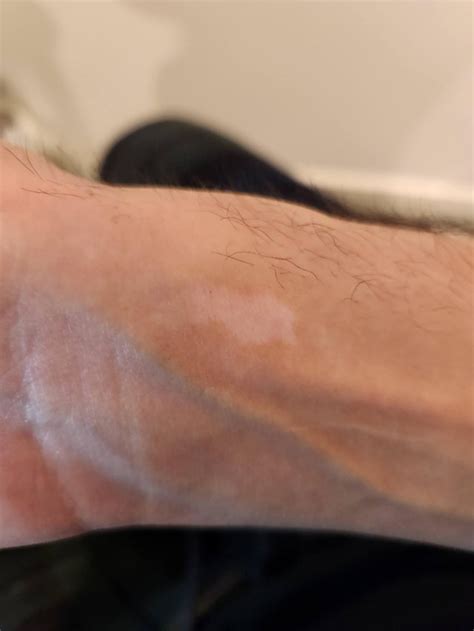 3-month Opzelura progress with Segmental Vitiligo (It works! But slowly ...