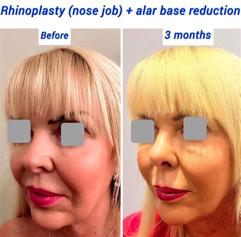 Alar Base Reduction (Nostril Reduction) - Harley Clinic