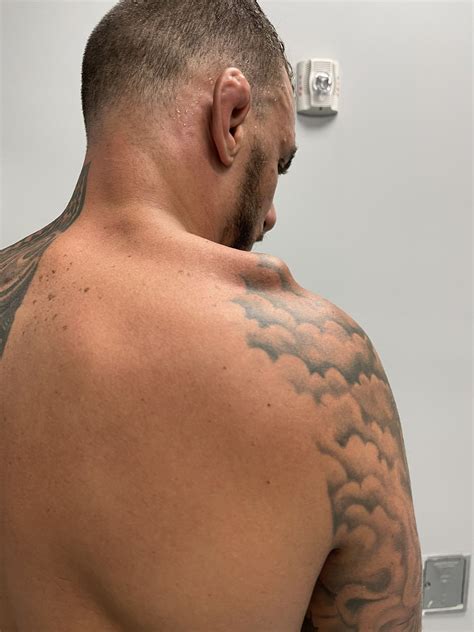 Renato Moicano suffered serious shoulder injury just weeks before win