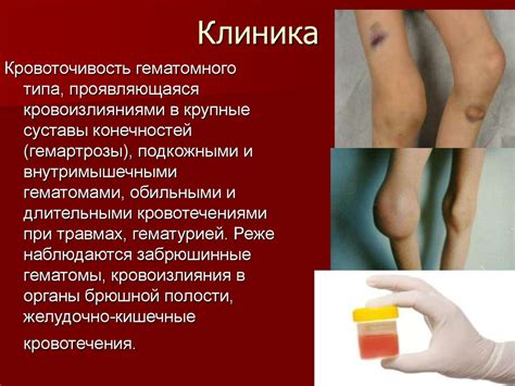 Гемофилия - презентация онлайн