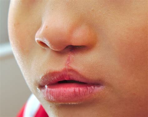 cleft palate     effect mydrcomau