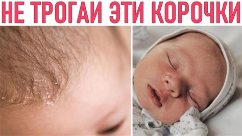 МОЛОЧНЫЕ КОРОЧКИ | Вот почему нельзя трогать молочные корочки у малыша ...