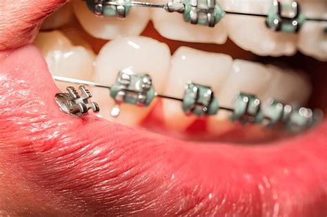 kelebihan  kekurangan behel metal  harganya klinik gigi satu