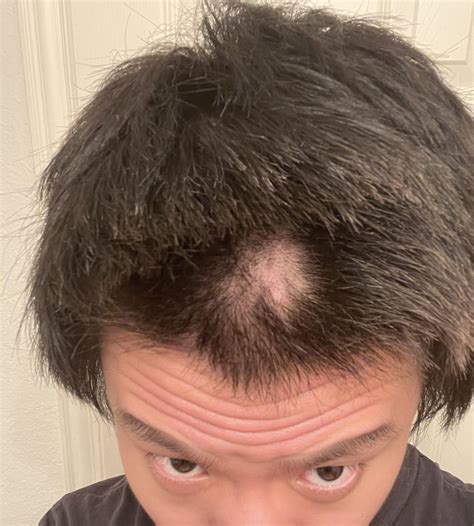 Bald spot on top of head for 3 weeks, will it grow back? Very worried I