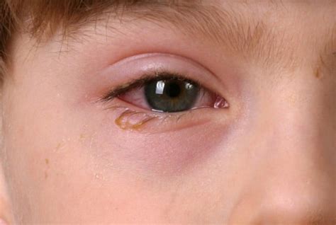 Allergic Reaction Swollen Eyes Child - Infoupdate.org