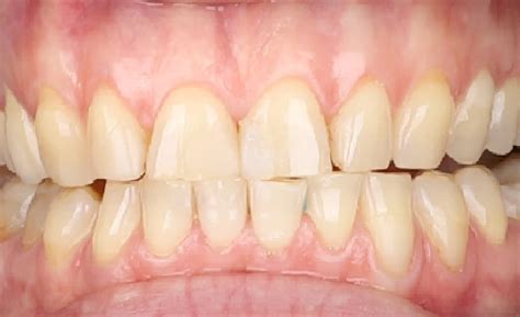 Ультратонкие виниры в стоматологической клинике Eurodental