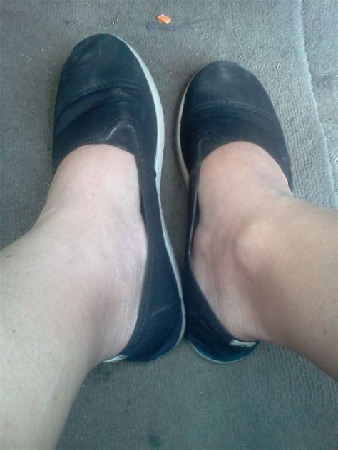 Life with Lupus: Swelling.....should I worry?