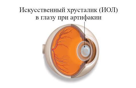 Артифакия глаза после замены хрусталика - что это и нужно ли лечить?