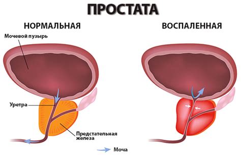 Бактериальный простатит: симптомы, лечение антибиотиками - Фото болезней