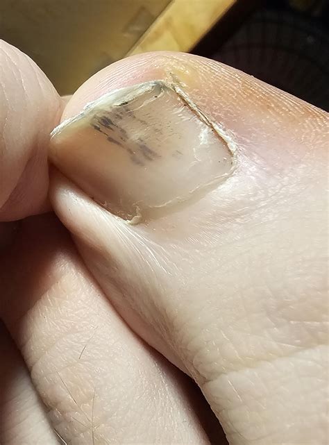 What are these dark marks underneath my toenail? : r/DermatologyQuestions