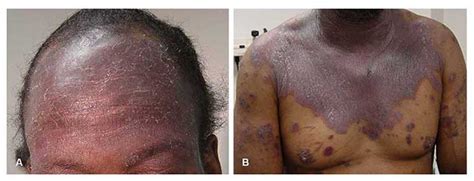 HIV (AIDS) Rash - Pictures, Symptoms and Treatment