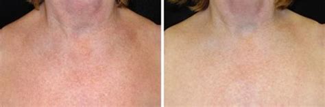 IPL Before and After photo gallery