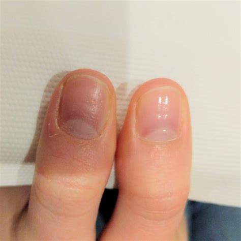 What Does A Bumpy Thumb Nail Mean at Darrell Coria blog