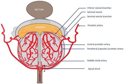 Prostate Artery Embolization: Challenges, Tips, Tricks, and Perspectives