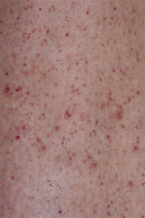 Meningococcal Meningitis: Causes, Symptoms, And Prevention - INFO CHANNEL