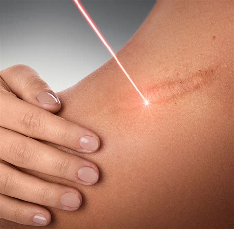 Laser Scar Removal Sharjah | Keloids Treatment Sharjah | Dr Sunny ...