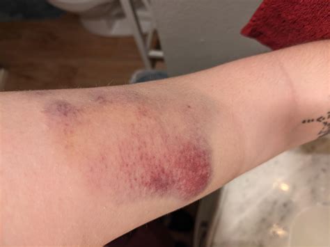 Best way to avoid pain from your covid booster: run into a doorknob