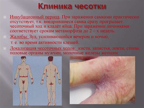 Чесотка. Педикулез. Роль медицинского персонала в профилактике ...