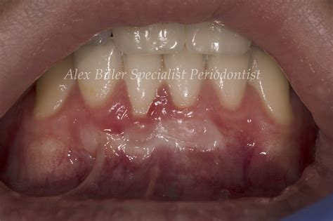 Perio Clinic -Treatment for gum recession