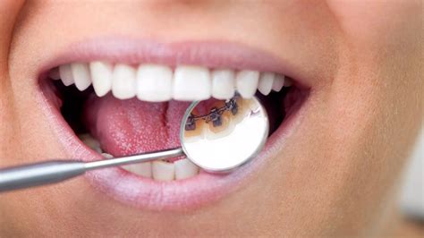 lingual treatment methods dentist dentist evrim cengiz