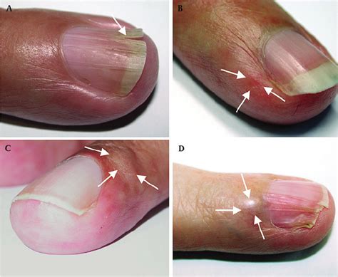 Fingernail and nailbed abnormalities in four patients with NF1 and ...