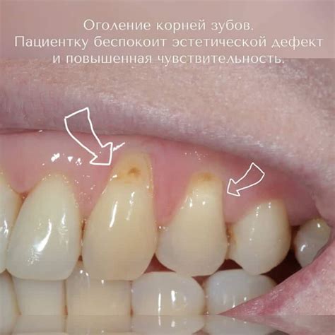 Стоит ли мириться с оголением корней зубов? | Стоматология «Артес»
