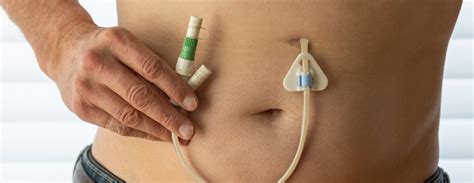 Tube Feeding (PEG and PEJ) Training for Support Workers: Face-to-Face ...
