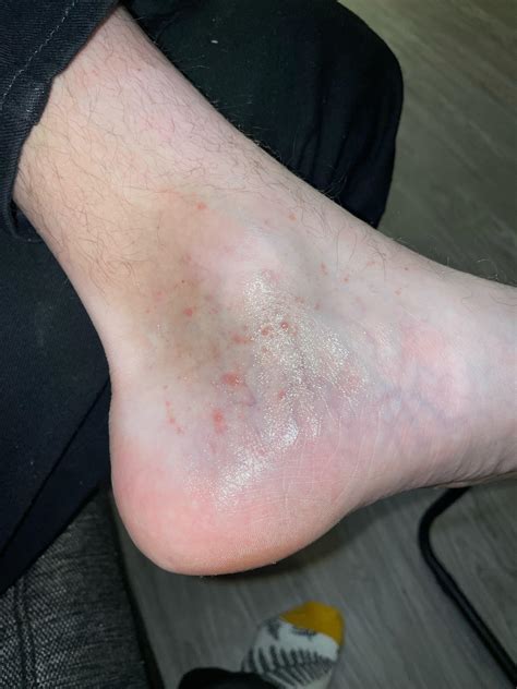 My boyfriend (26m) has this small bumps on his foot for months. What is
