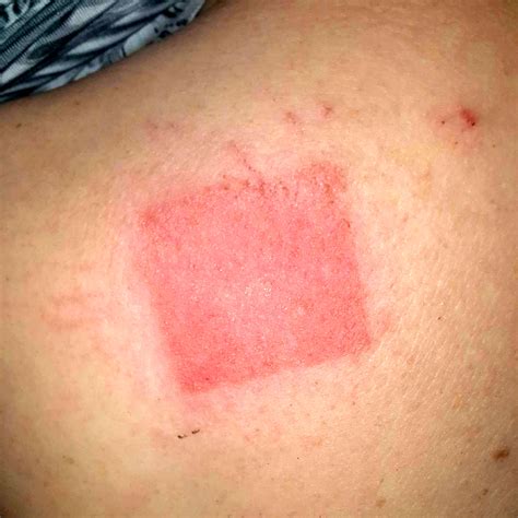 Leathery Skin Rash
