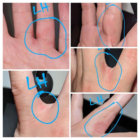 Learning how to identify burrows/track lines : r/scabies