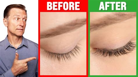 How to Grow Long Thick Eyelashes QUICKLY! - Dr. Berg - YouTube