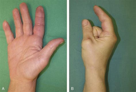 Cardinal Signs Of Flexor Tenosynovitis