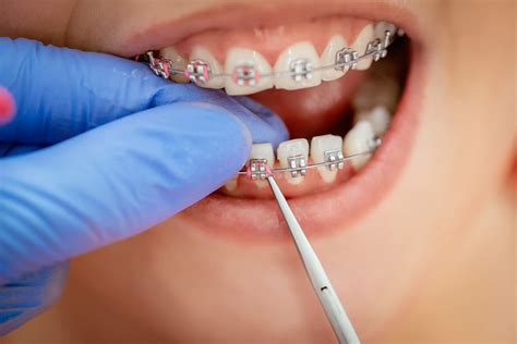 Can Braces Fix Gaps In Teeth? | Orthodontist Vaughan, Braces Vaug