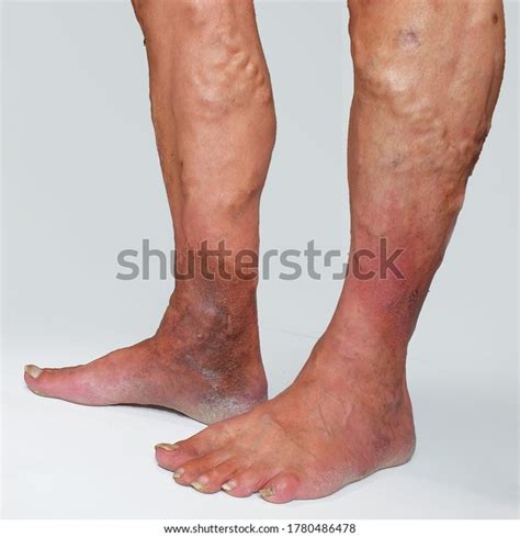 147 Venous Eczema Stock Photos, Images & Photography | Shutterstock