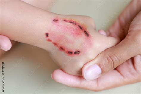 sticker wound  blood   bite human teeth  child hand dress