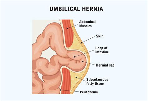 Umbilical Hernia after Delivery: Causes, Signs & Treatment