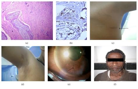 Lisch nodule - wikidoc