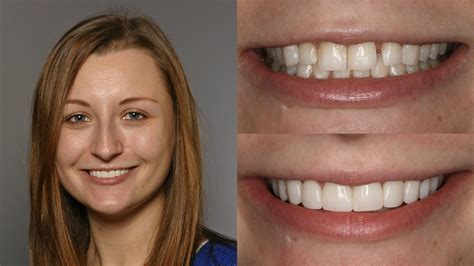 Veneers For Misaligned Teeth at Jeremy Livingstone blog